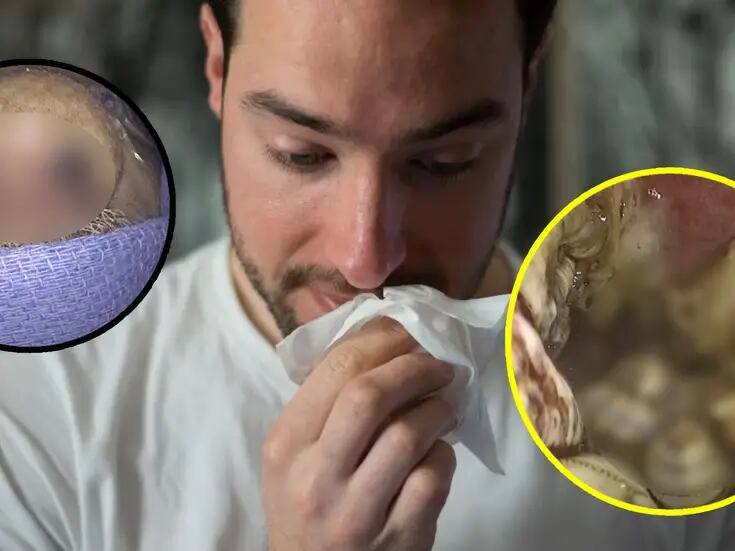 VIDEO: Hombre de Florida tenía 150 larvas vivas dentro de su nariz alimentándose de él