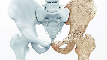 Osteoporosis: ¿síntomas y cómo tratarla?