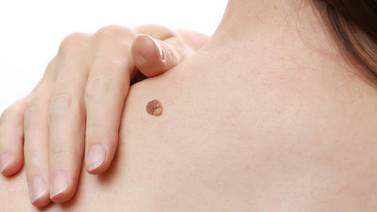 ¿Qué es el melanoma y cómo tratarlo?