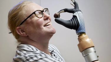 Karin es la primera persona en poseer una mano biónica integrada con sistema nervioso y esquelético