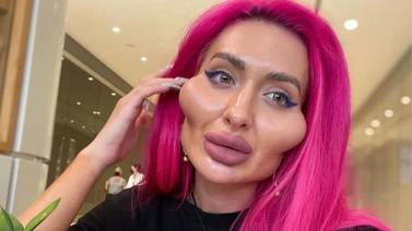 Influencer ucraniana famosa por tener “las mejillas más grandes del mundo” comparte su apariencia antes de tener rellenos 