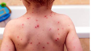 IMSS pide atender a tiempo la varicela