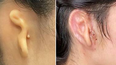 Mexicana recibe implante de oído creado en 3D con sus propias células