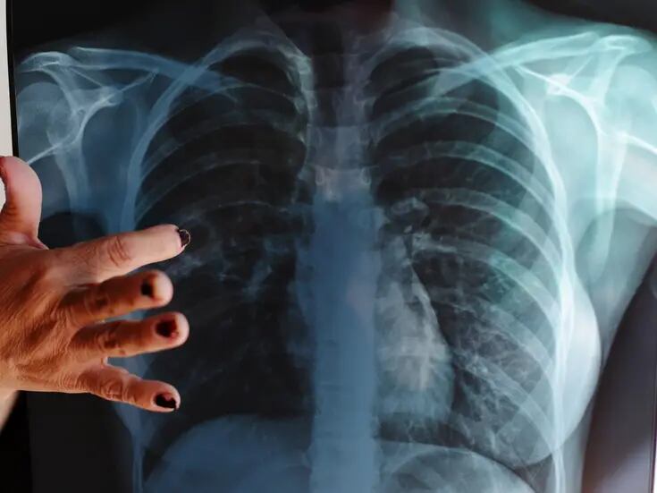 Ocupa BC primer lugar en casos nuevos de tuberculosis
