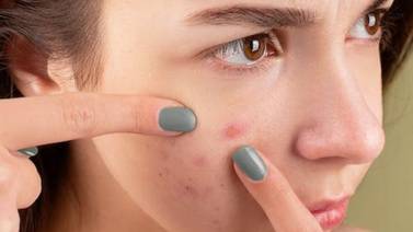 Estudio confirma que las personas son percibidas con mayor desprecio por tener acné