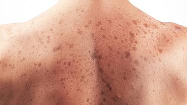 Cuida tu piel del melanoma este verano