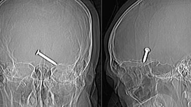 CONTENIDO FUERTE: Extraen clavo del cerebro tras disparo accidental con pistola de clavos en el ojo