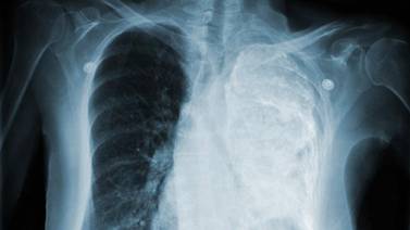 Fallecen 250 por tuberculosis en un año en BC