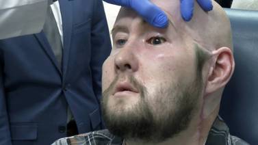 Cirujanos han realizado el primer trasplante de ojo completo del mundo
