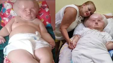 La "bebé" con hidrocefalia cuya cabeza no deja de crecer; madre responde a quienes se burlan de ella en internet