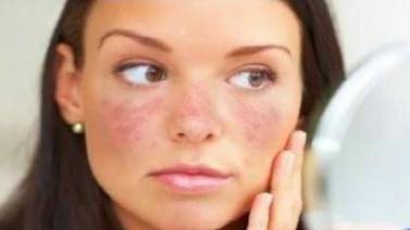 Lupus afecta a 9 mujeres por cada hombre