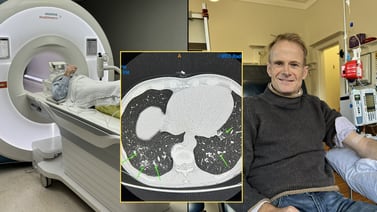 Doctor con cáncer terminal se somete a su propio tratamiento único en el mundo y se recupera por completo