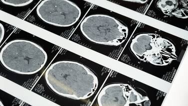 ¿Cuáles son los síntomas de los tumores cerebrales?