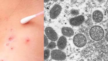 Cofepris autoriza ensayo clínico de medicamento contra mpox