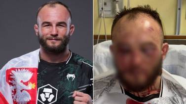 FOTO: Peleador polaco muestra cómo acabó con el rostro desfigurado tras su derrota en UFC