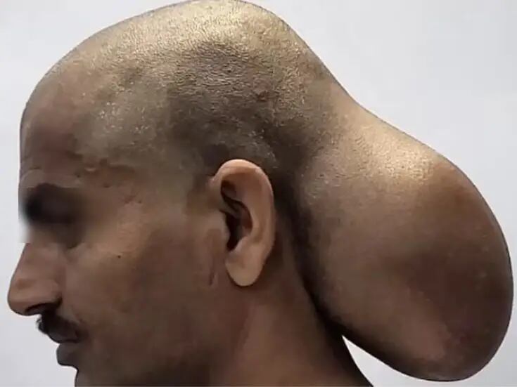 Hombre pasó 15 años con un tumor extremadamente raro del tamaño de su cabeza