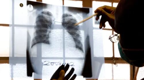 Aumento récord de casos de tuberculosis en EU en 2023