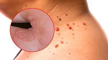 VPH: Cómo detectar el Virus del Papiloma Humano en Mujeres y Hombres