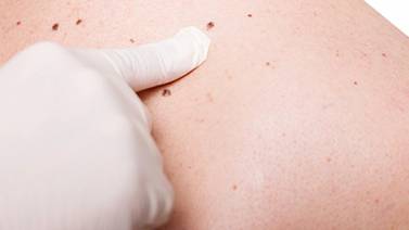 ¿Sabías que el melanoma puede estar oculto en tu cuerpo?