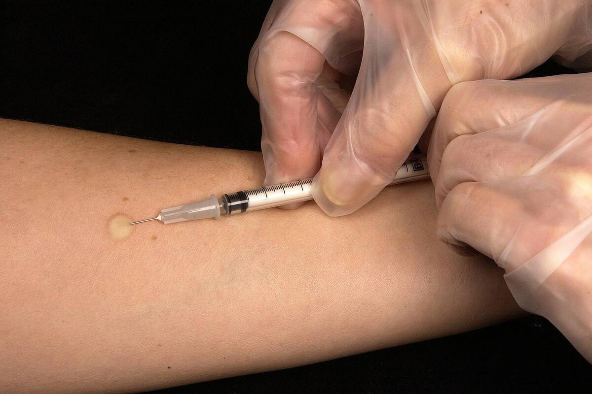 La tuberculosis sigue siendo una emergencia de salud pública