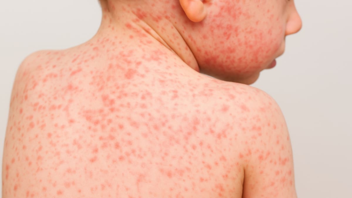 México registra más de 4,000 casos confirmados de sarampión en 2025: hay 74 activos en nueve estados y 23 defunciones; autoridades intensifican vacunación nacional