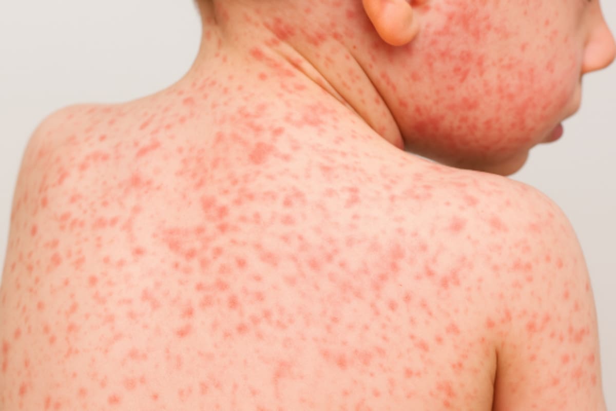 México registra más de 4,000 casos confirmados de sarampión en 2025: hay 74 activos en nueve estados y 23 defunciones; autoridades intensifican vacunación nacional