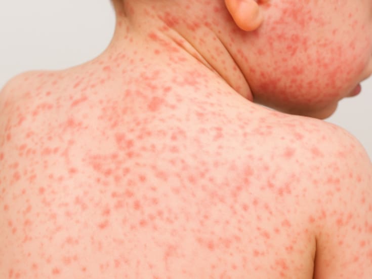 México registra más de 4,000 casos confirmados de sarampión en 2025: hay 74 activos en nueve estados y 23 defunciones; autoridades intensifican vacunación nacional