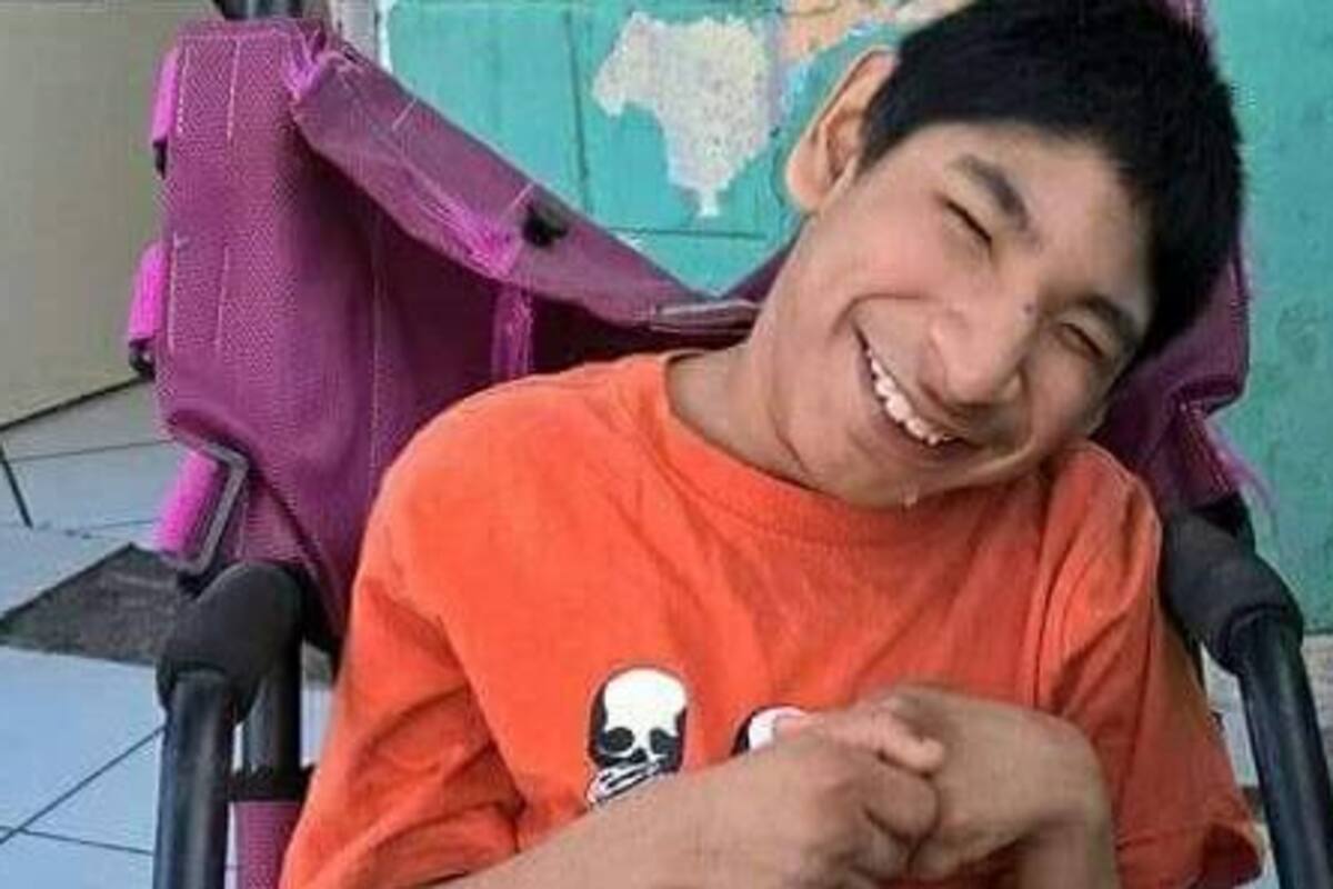 Murió Ángelo el niño con micocefalia
