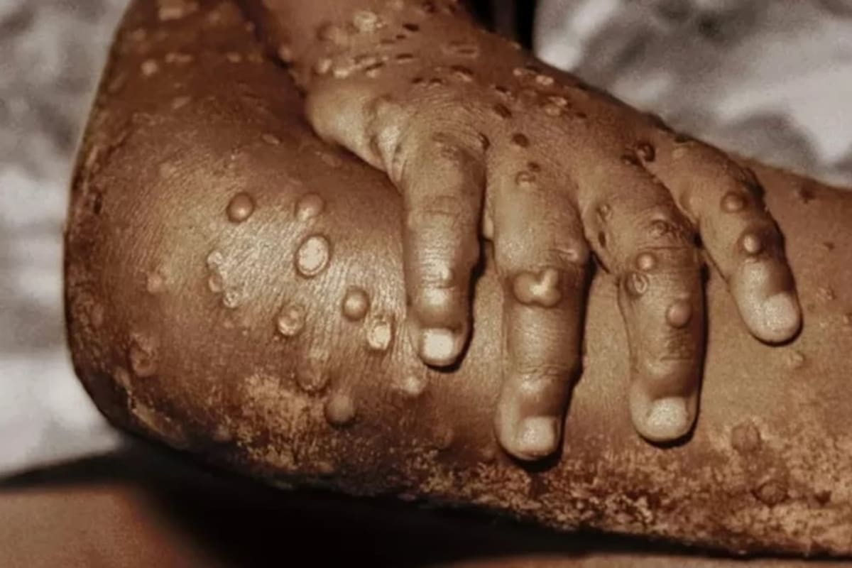 Toman medidas contra la viruela del mono en central camionera de CO