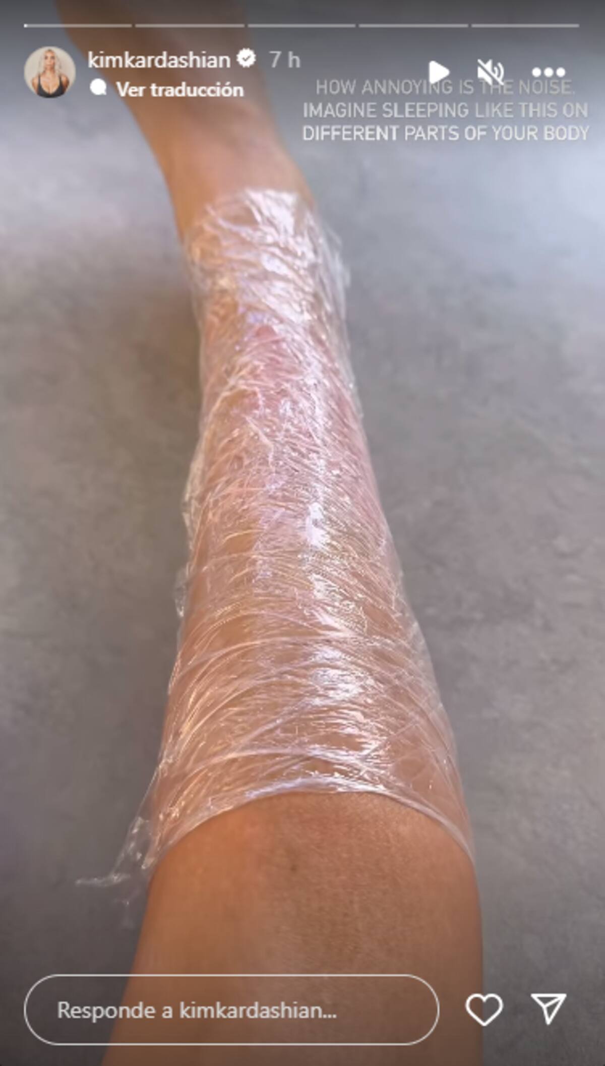 Kim Kardashian compartió en sus historias su remedio para los brotes de psoriasis.