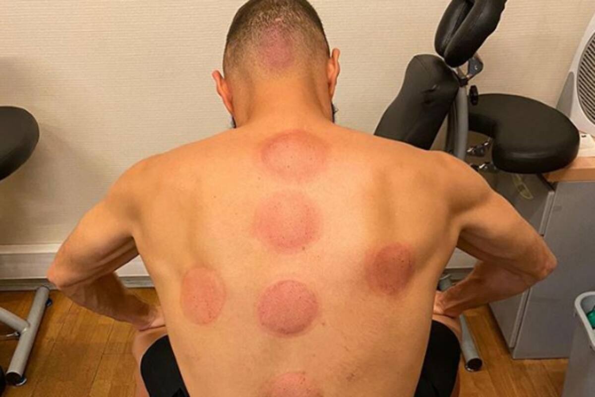 Karim Benzema muestra los estragos de la ventosaterapia en su cuerpo
