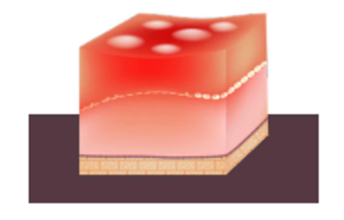 Quemadura de segundo grado. / PROFECO.
