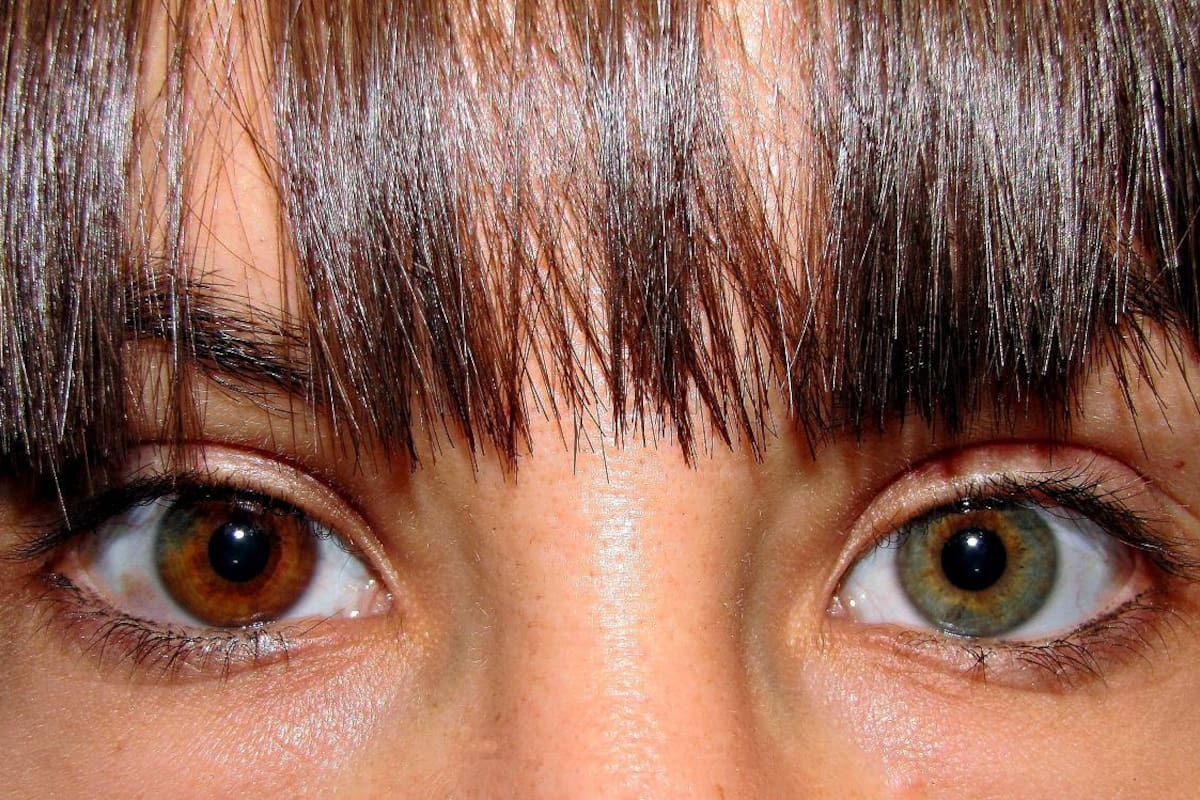 ¿Por qué algunas personas tienen el iris bicolor? La ciencia lo explica