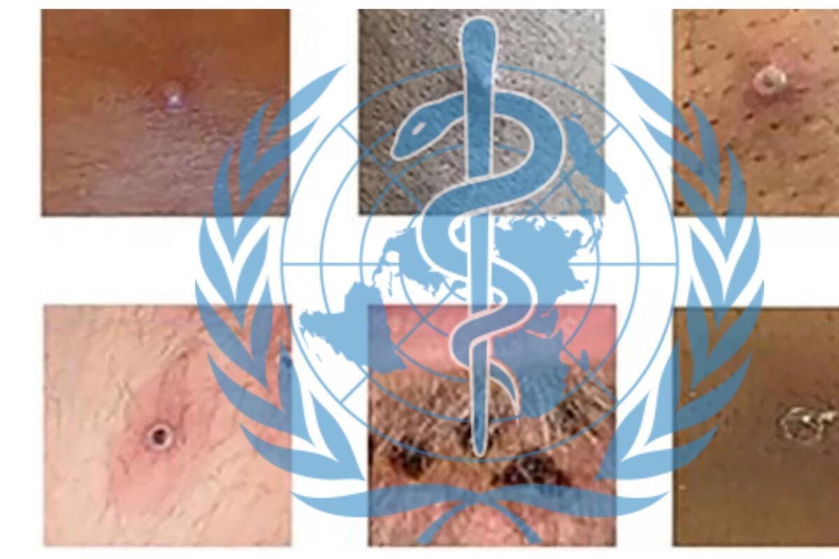 Viruela del mono: ¿Qué cambia con la declaración de emergencia mundial que hizo la OMS?