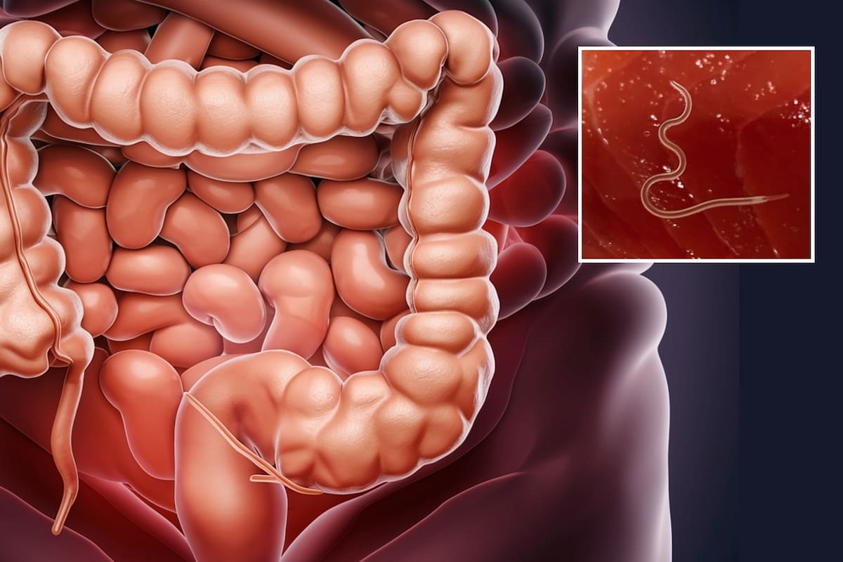 Estudio: Hay posible relación entre gusano de estómago y cáncer de colon