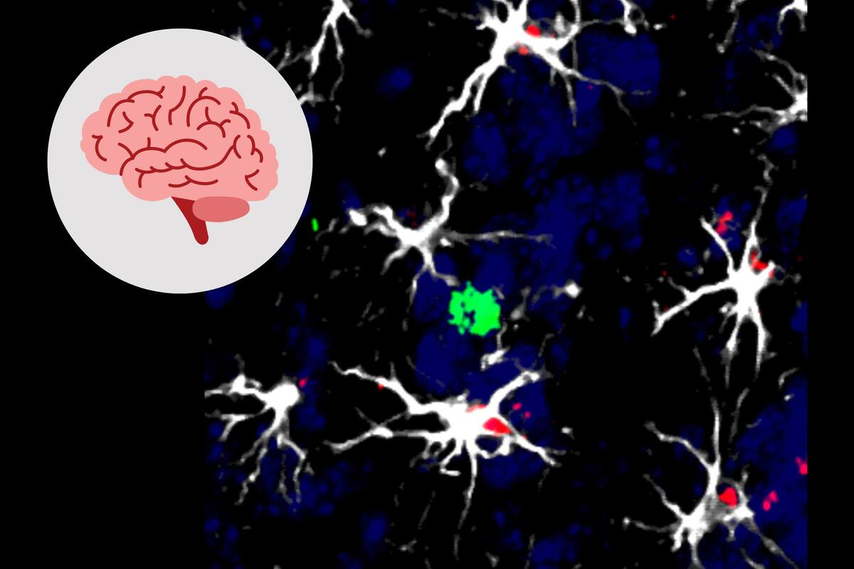 Encuentran células cerebrales ‘traidoras’ que facilitan la metástasis
