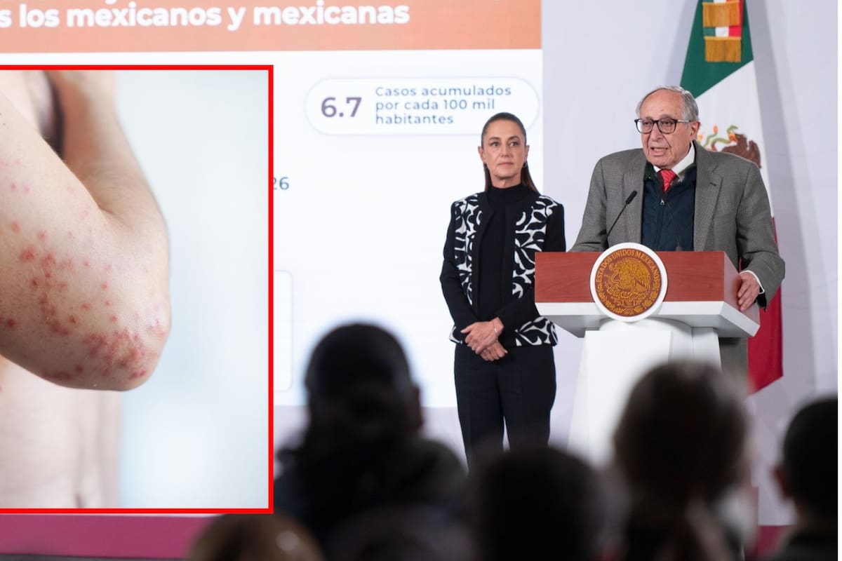 Brote de sarampión en México provoca 28 muertes; Salud advierte que casi todos los fallecidos no tenían vacuna