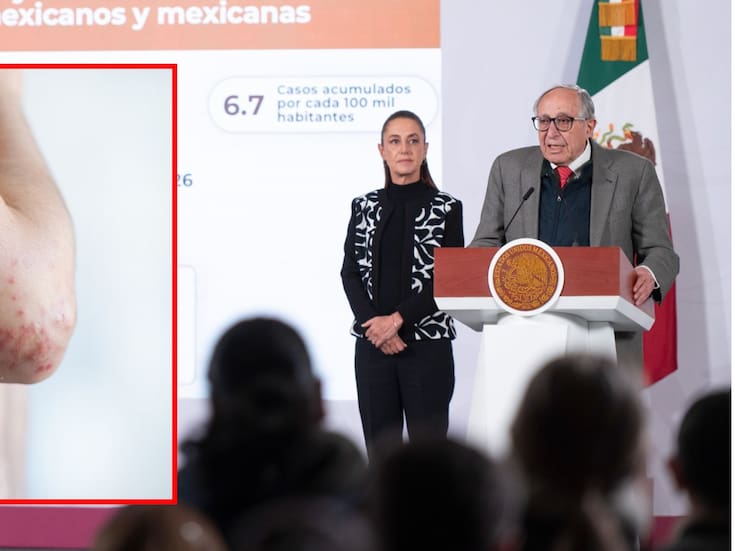 Brote de sarampión en México provoca 28 muertes; Salud advierte que casi todos los fallecidos no tenían vacuna