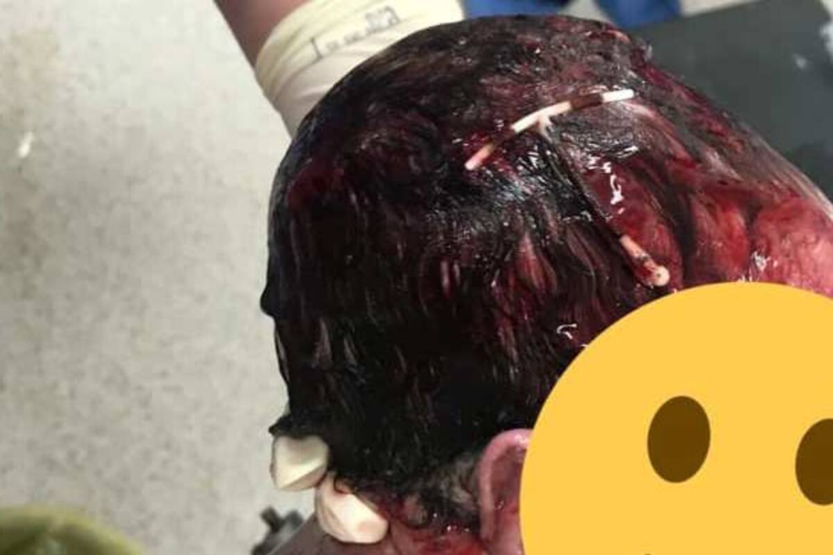 "Usa métodos anticonceptivos me dijeron”, bebé nace con DIU pegado en la cabeza