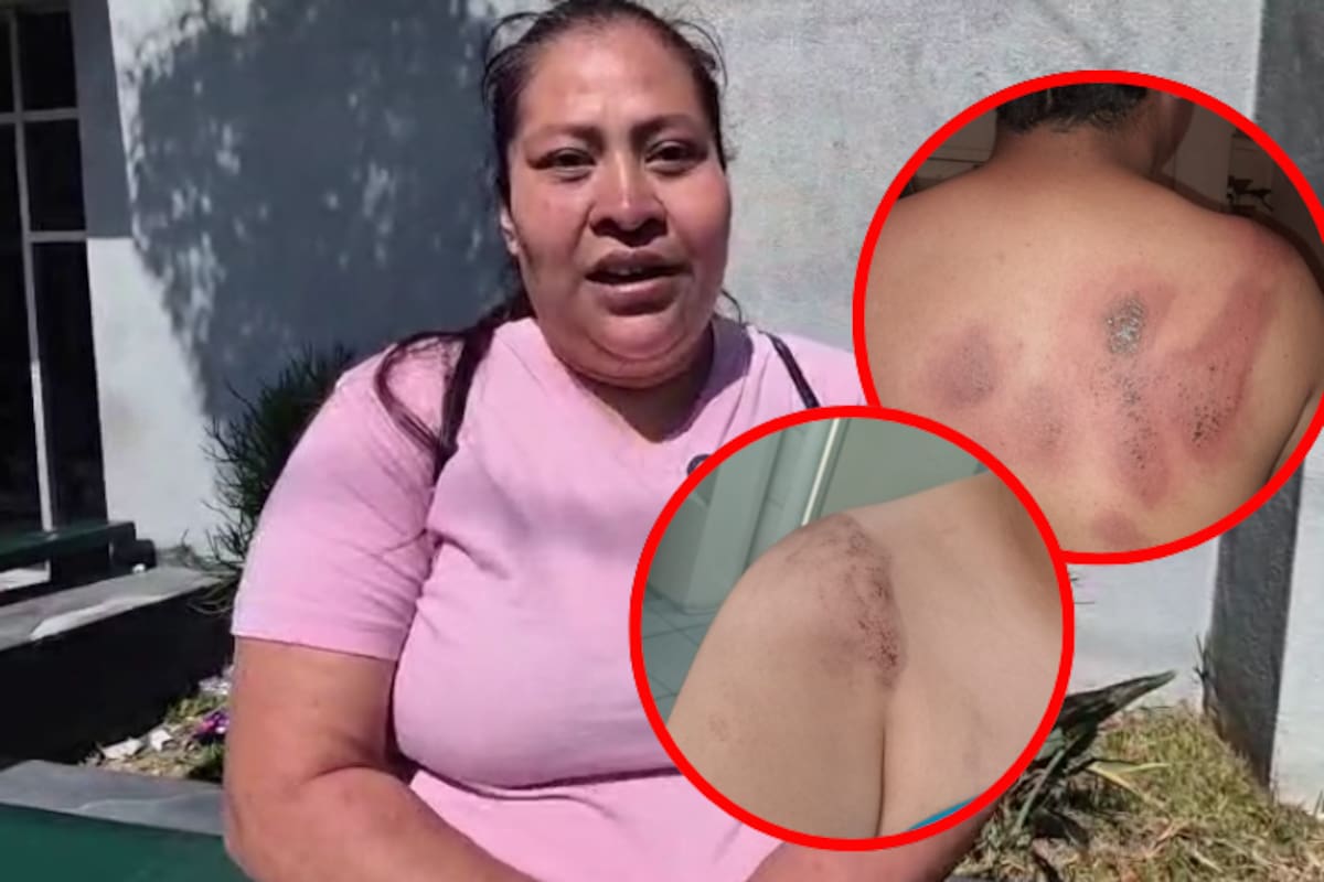 Queman estudiantes de secundaria a su compañero con sosa cáustica