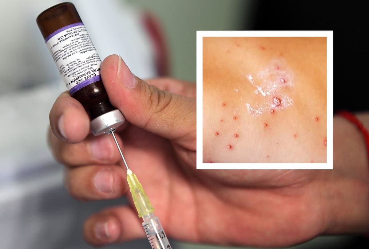 Sólo dos entidades han confirmado casos de esta enfermedad viral sumamente contagiosa causada por el virus del sarampión. FOTO: ESPECIAL