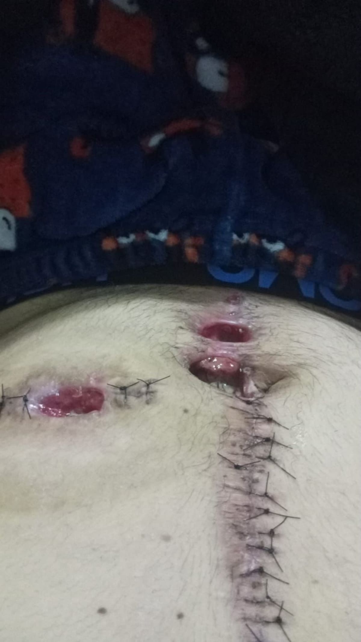 Se recupera de una reconstrucción que tardará por lo menos un año. Foto: Cortesia