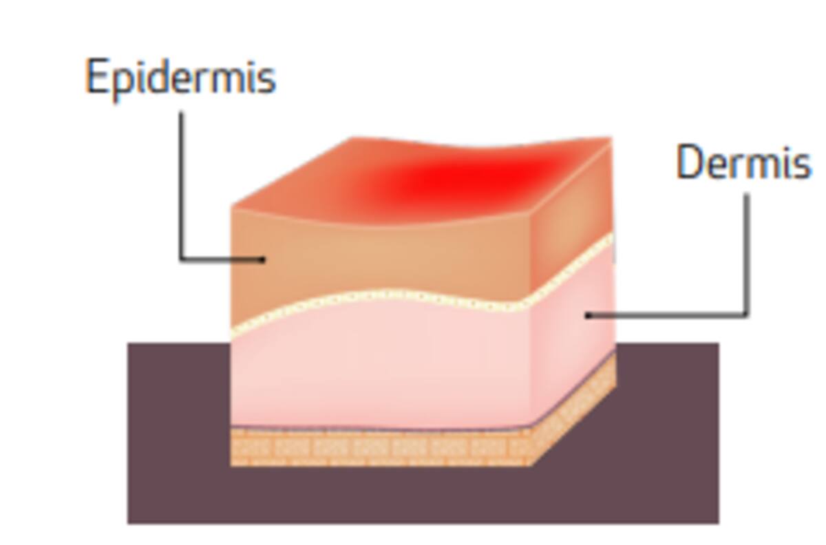 Quemadura de primer grado. / PROFECO.