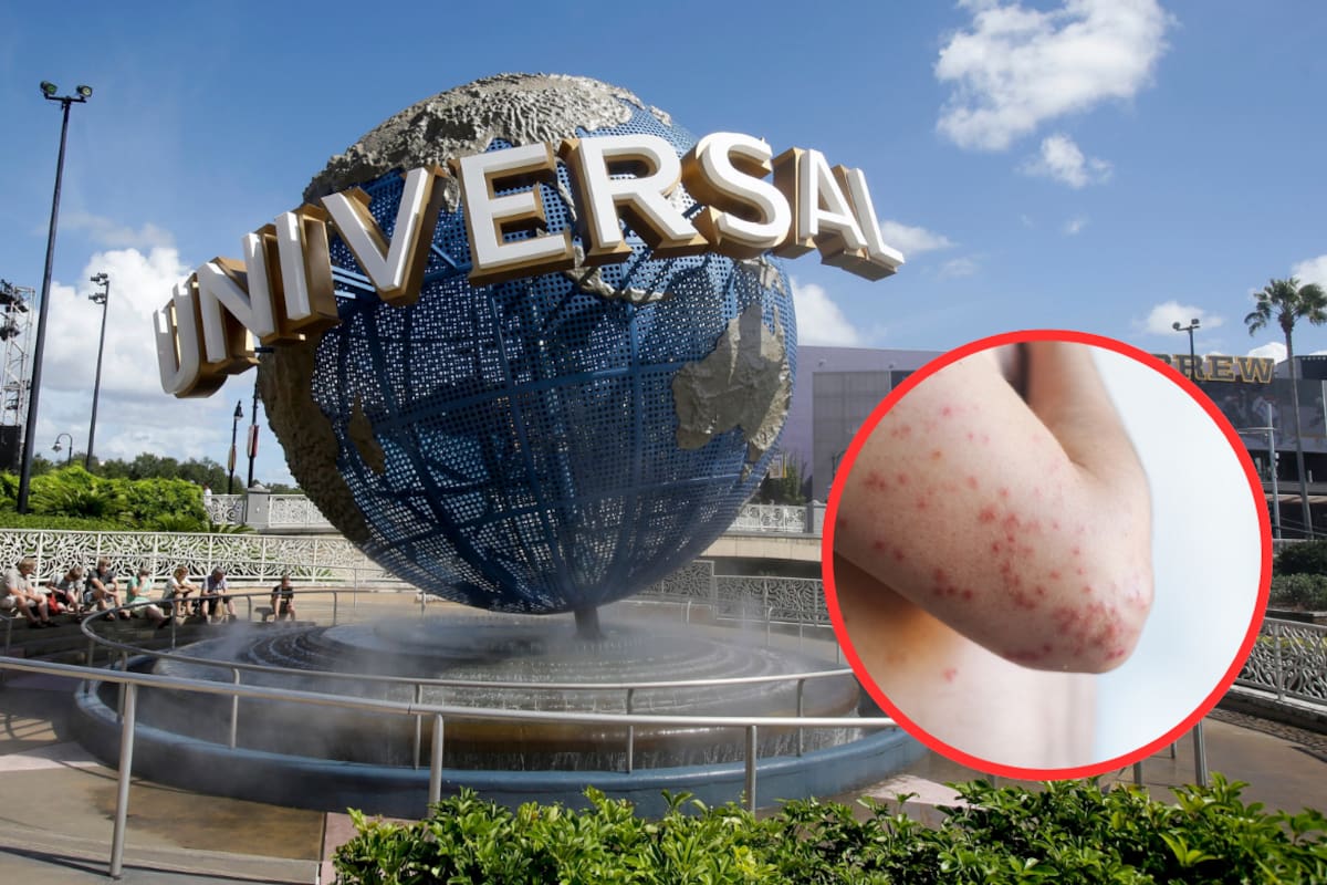 Visitantes de parque Universal Studios Hollywood pudieron estar expuestos al sarampión y deben permanecer atentos a los síntomas