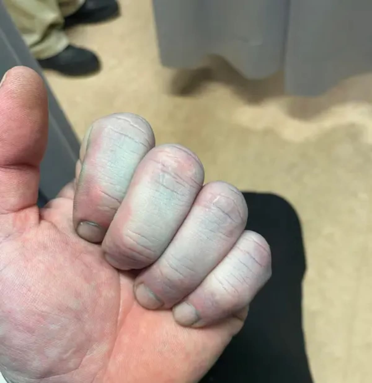 El caso ocurrió en Inglaterra cuando un hombre de 42 años fue hospitalizado por sospecha de falta de oxígeno, hasta que una prueba médica reveló que el pigmento de su ropa de cama se había transferido a la piel. Foto: Tommy Lynch / SWNS