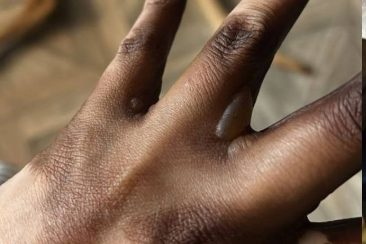 VIDEO: Funcionaria de casilla en México sufre quemadura por tinta electoral