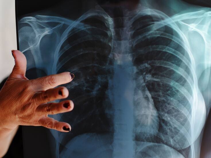 Sonora registra mil 322 casos de tuberculosis; Hermosillo concentra 51.2%
