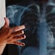 Sonora registra mil 322 casos de tuberculosis; Hermosillo concentra 51.2%