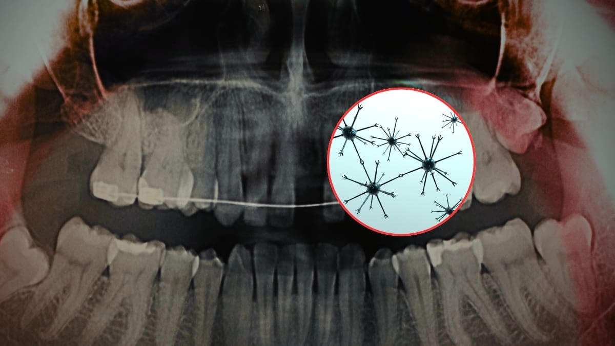 Científicos crearon nanorobots magnéticos para eliminar la sensibilidad dental en solo 20 minutos, penetrando hasta 500 micrómetros dentro del diente para sellar la dentina desde el interior, lo que daría alivio duradero sin necesidad de usar pastas especiales o ir al dentista