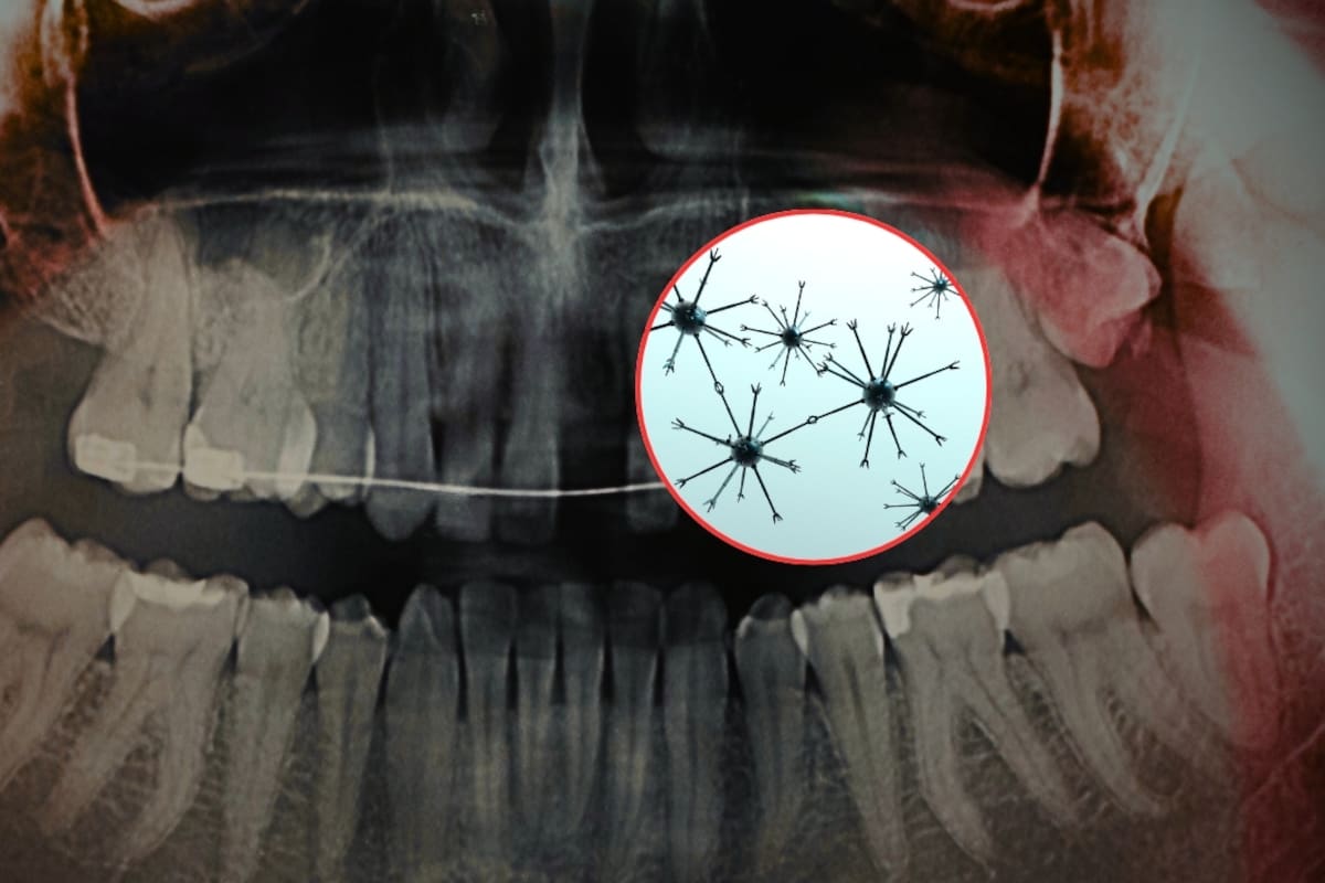 Científicos crearon nanorobots magnéticos para eliminar la sensibilidad dental en solo 20 minutos, penetrando hasta 500 micrómetros dentro del diente para sellar la dentina desde el interior, lo que daría alivio duradero sin necesidad de usar pastas especiales o ir al dentista
